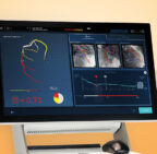 New AI Technology for Cardiac Care Improves Visualization of Heart Blockages